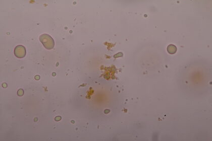Sample from Deepwater Horizon spill site, showing oil eating bacteria (large shapes) and crude oil droplets (small shapes)
